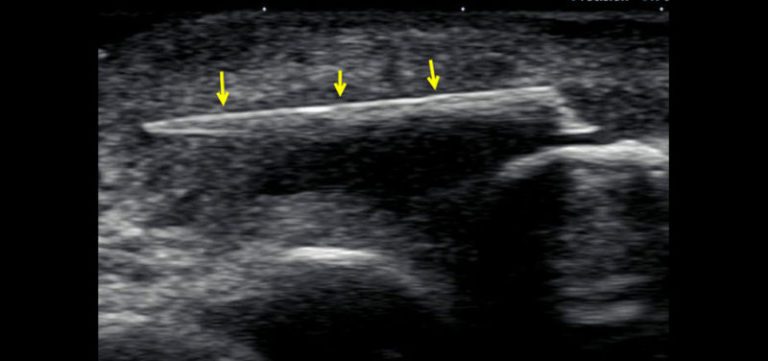 Ultrasound-guided detection of foreign bodies in soft-tissue - SONOSIF ...