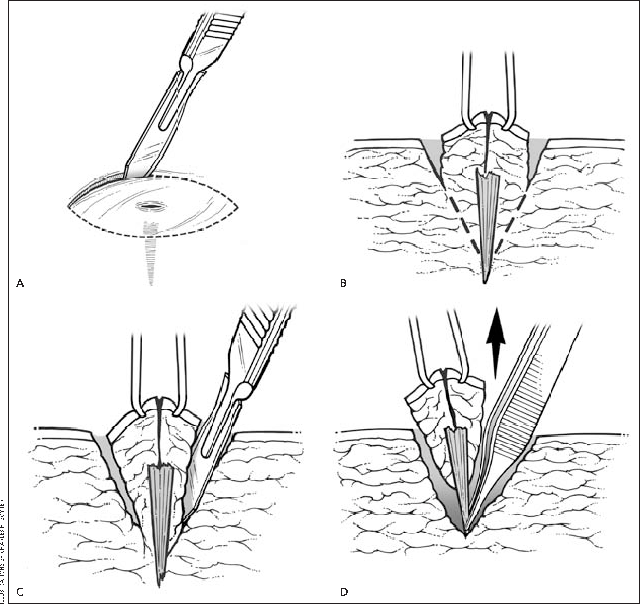 ultrasound-guided-detection-of-foreign-bodies-in-soft-tissue-sonosif