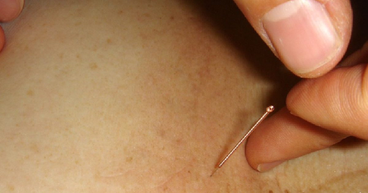 Akupunktur Evaluering af de biomekaniske virkninger af nålemanipulation på væv