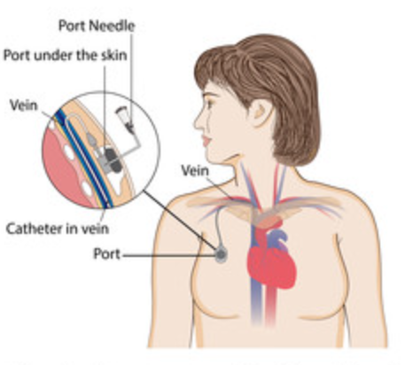 CVC: catetere venoso centrale