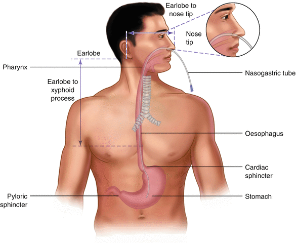 Confirmació de la col·locació del tub nasogàstric