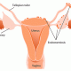 Endometriosi infiltrante profonda (DIE)