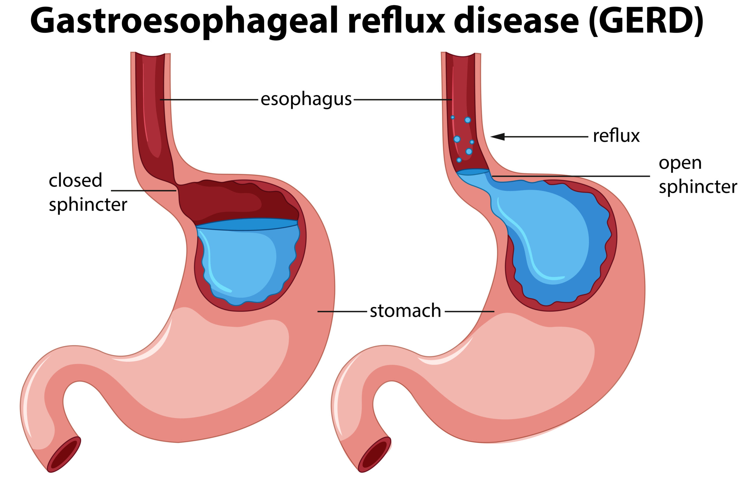 Gastroesophageal Reflux Disease Gerd Sonosif By Sifsof California