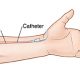 Insertion Of An Arterial Catheter: IAC