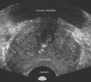 Transrectal Prostate Ultrasound (TRUS) - SONOSIF - by SIFSOF, California