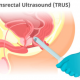 Transrektal prostata-ultralyd (TRUS)