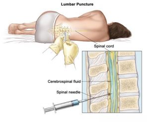 Ultrasound Guidance Lumbar Puncture - SONOSIF - by SIFSOF, California