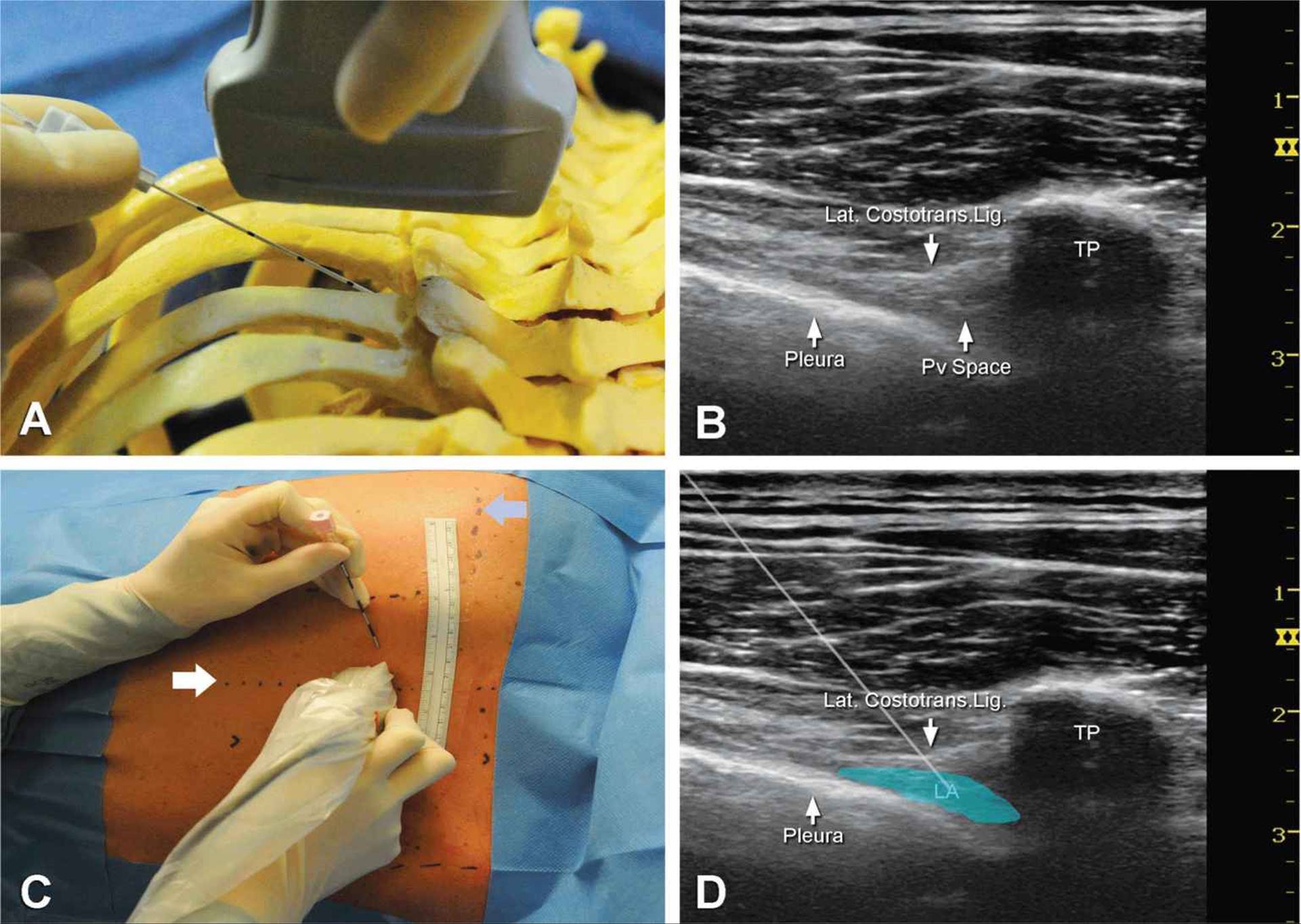 UltrasoundGuided Thoracic Paravertebral Block SONOSIF by SIFSOF, California