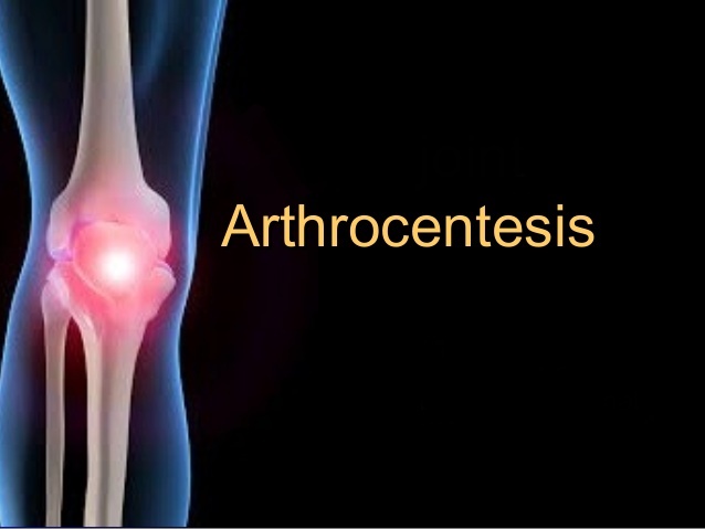 Artrocentesi guidata da ultrasuoni