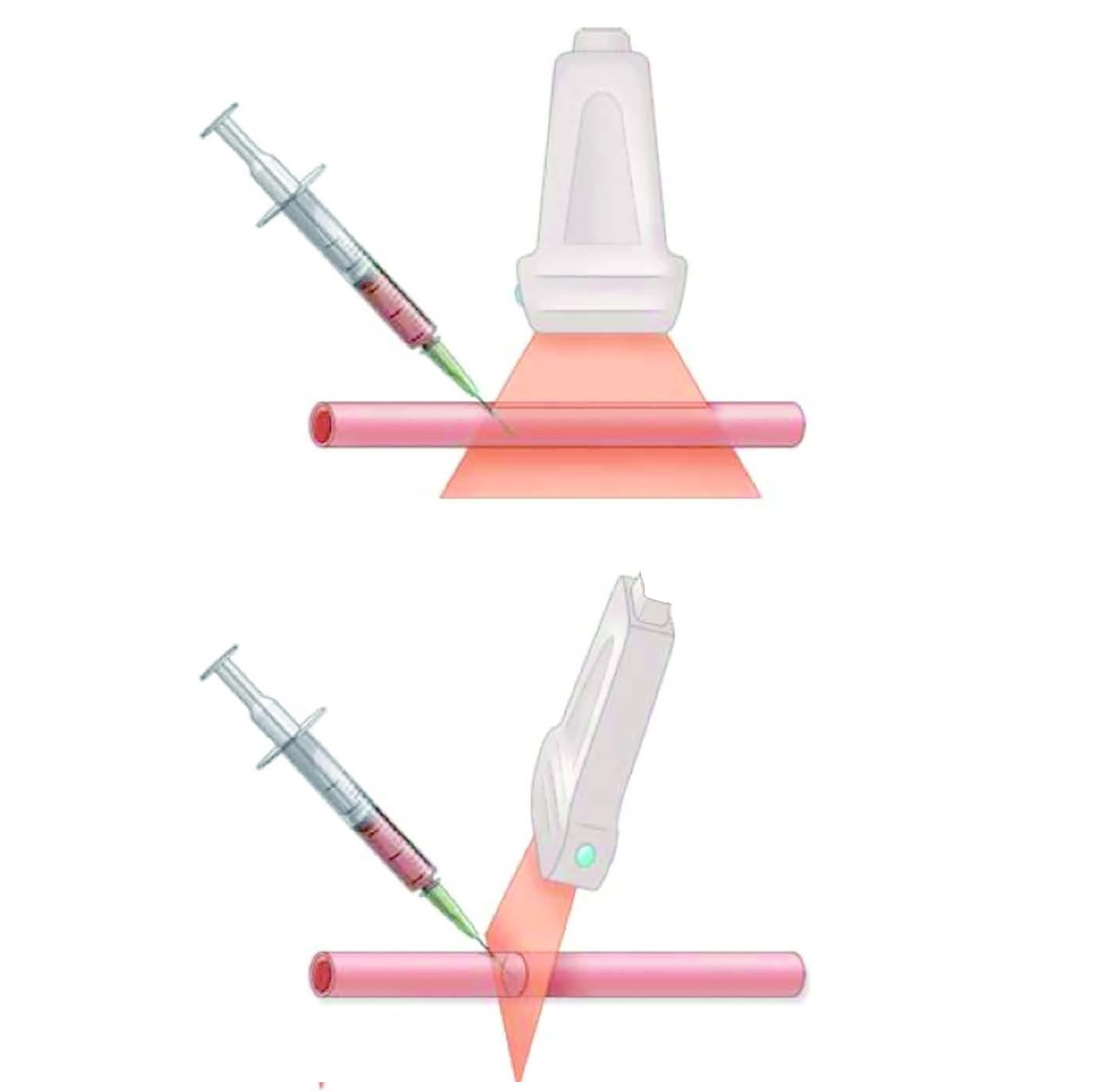 Ultrasound-guided Vascular Cannulation - SONOSIF - By SIFSOF, California