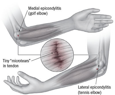 Lateral og medial epicondylitis