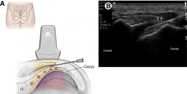 Ultrasound-guided Caudal Injection - SONOSIF - by SIFSOF, California