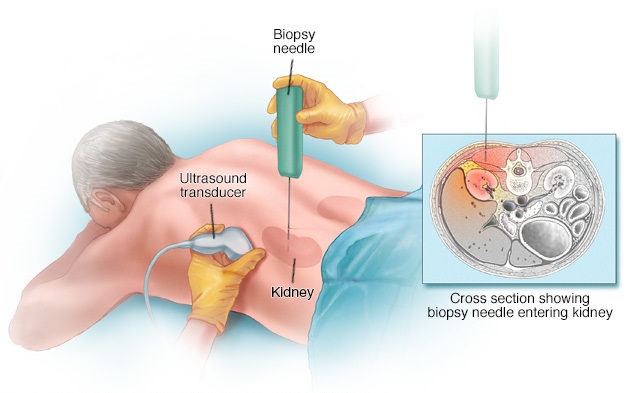 Biòpsia renal guiada per ultrasons