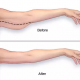 Lifting del braccio superiore guidato da ultrasuoni