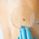 Brug af ultralydsscannere til fjernelse af hudtumorer
