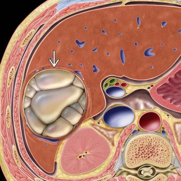 Ultrasound-Guided Hydatid Cyst Diagnosis - SONOSIF