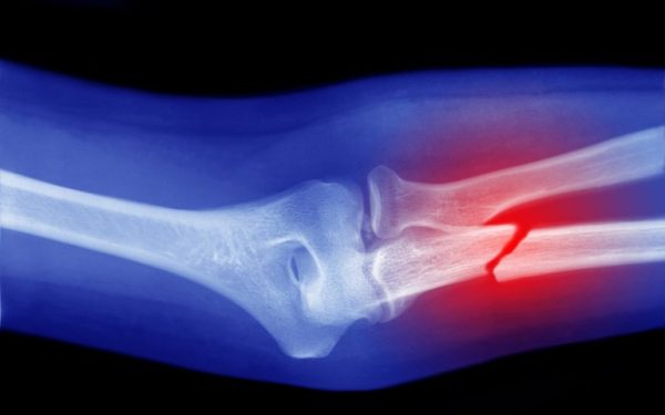 Chographie Suite Fractures Luxations Entorses Et Traumatismes Sportifs