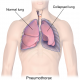 M-modus echografie voor het identificeren van een pneumothorax