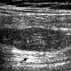Bruken av ultralydskanner i veiledende fettgrå intramuskulært