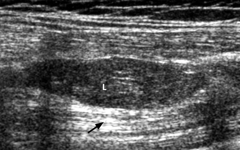 Penggunaan Pengimbas Ultrasound dalam Membimbing Intramuskular Kelabu Lemak