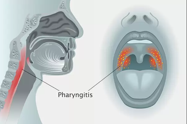 Pharyngitis Ultrasound Diagnosis