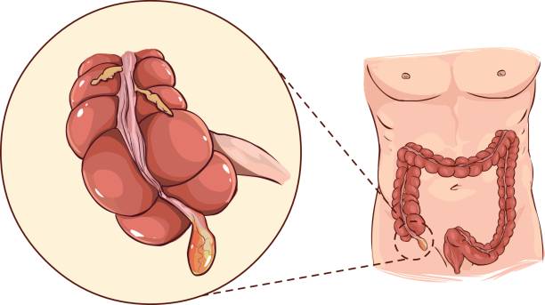 Illustrazione vettoriale di una con dettaglio di un'appendicite