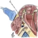 Rollen för linjära ultraljudsskannrar i anestesi-återupplivning och smärtstillande terapi