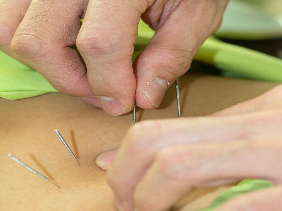 Acupuncture Evaluating the biomechanical effects of needle manipulation on tissue