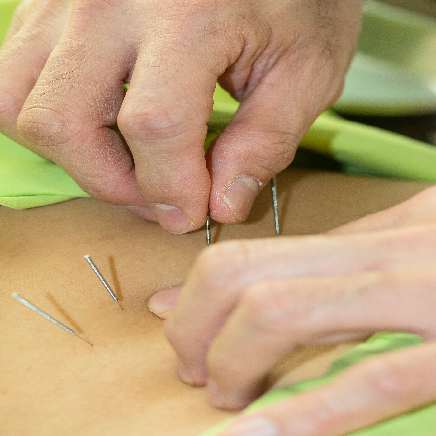 Acupuncture Evaluating the biomechanical effects of needle manipulation on tissue