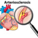 Arteriosclerosi