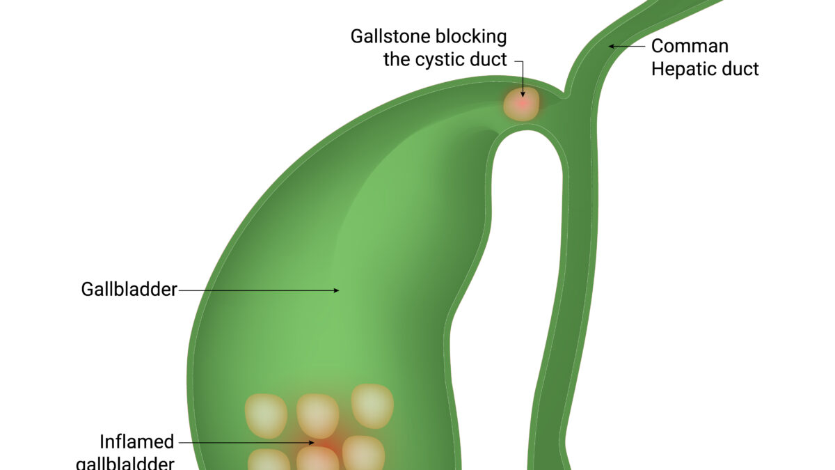 Diagnosing Gallstones with Ultrasound Scanning