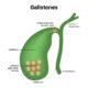 Diagnostisering av gallestein med ultralydskanning