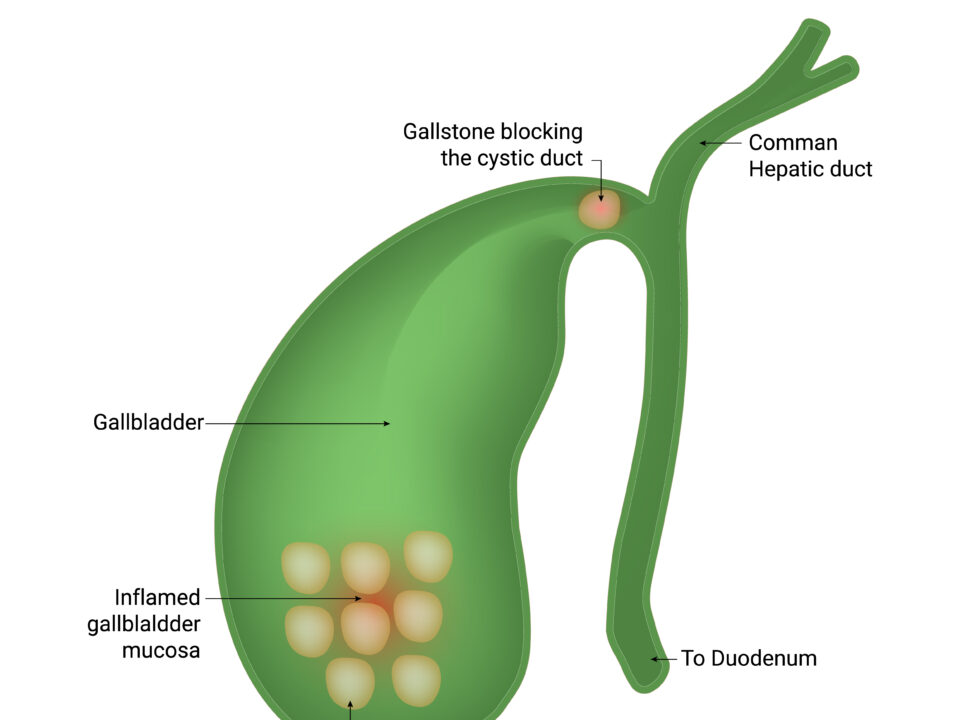 Diagnosing Gallstones with Ultrasound Scanning