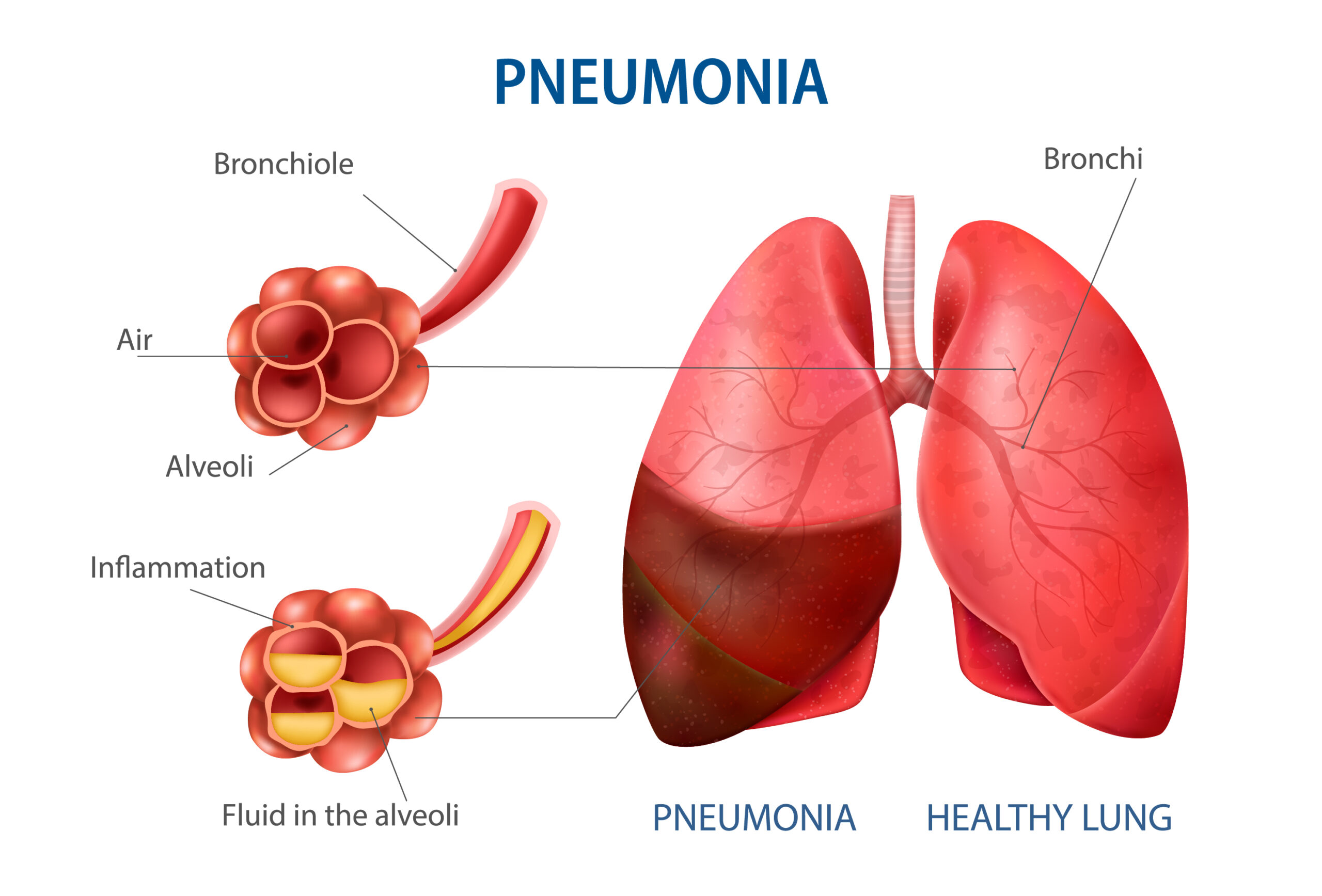 Diagnosing Pneumonia Through Ultrasound