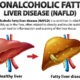 Ikke -alkoholholdig fet leversykdom ved siden av ultralyddiagnose
