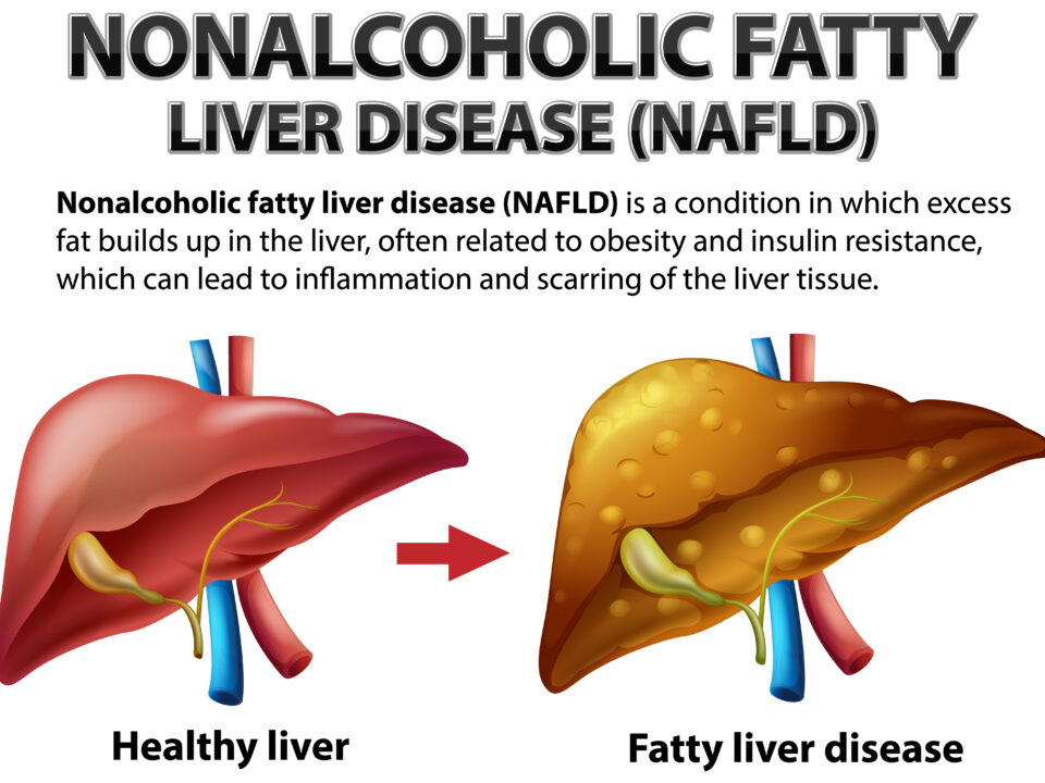 Nonalcoholic Fatty liver Disease Bedside Ultrasound Diagnosis