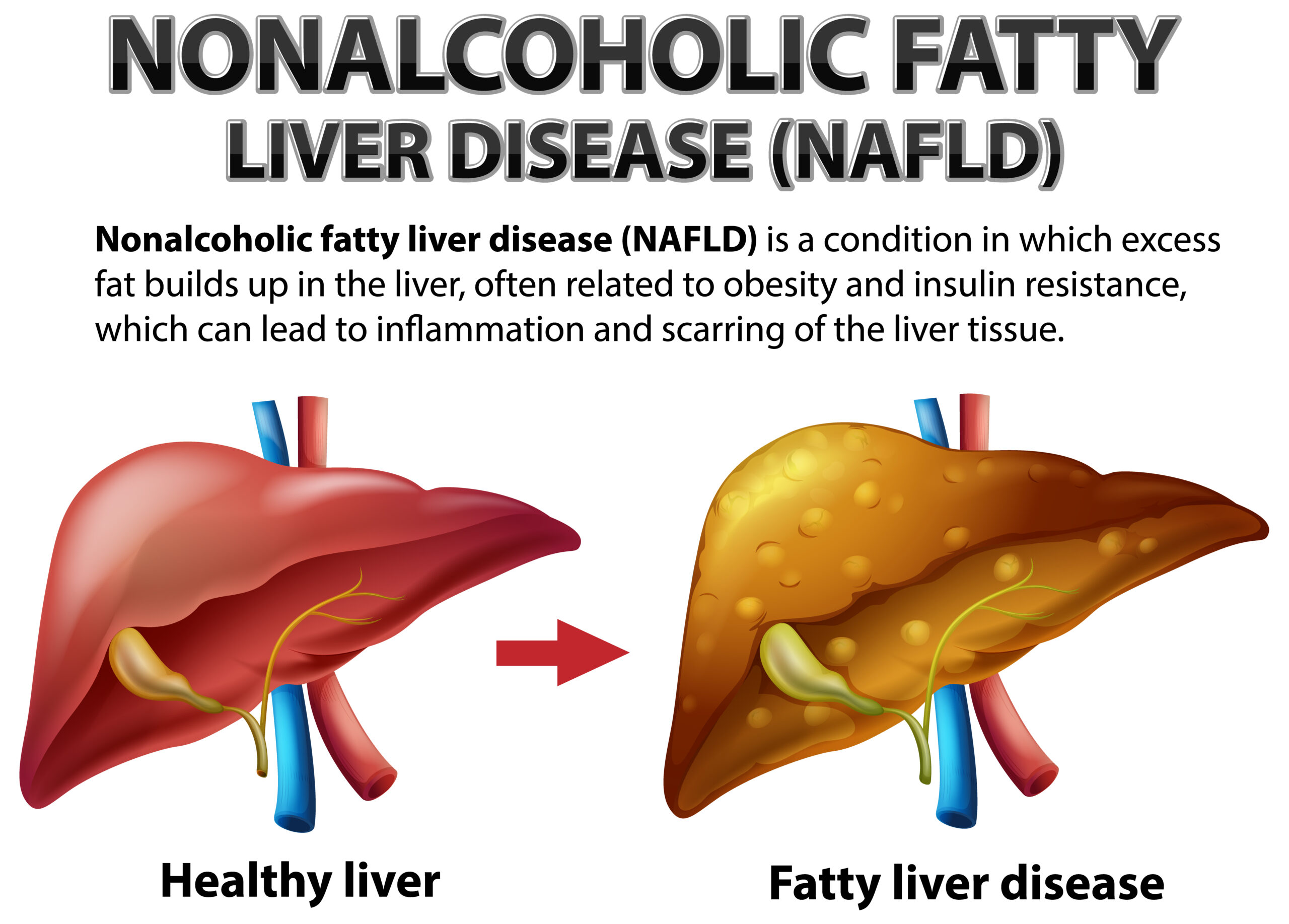 Nonalcoholic Fatty liver Disease Bedside Ultrasound Diagnosis
