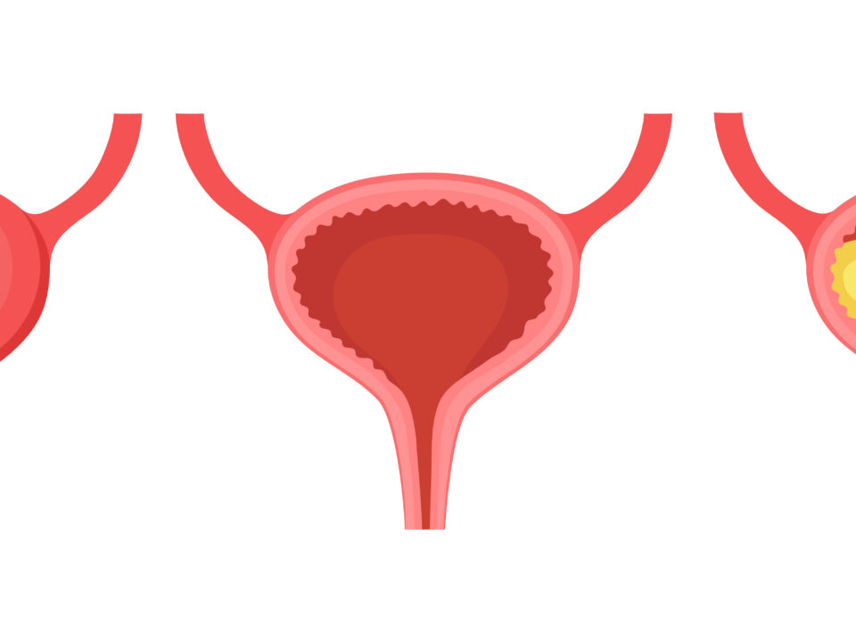 Post-Void Bladder