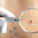 Brug af ultralydsscannere til fjernelse af hudtumorer