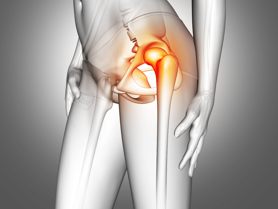 Ultrasonographic Evaluation of Trochanter Bursitis
