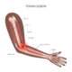 Ultralydveiledet lateral og medial epikondylitt
