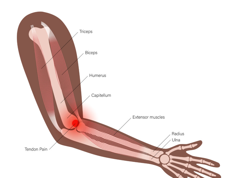 Ultrasound-Guided Lateral and Medial epicondylitis