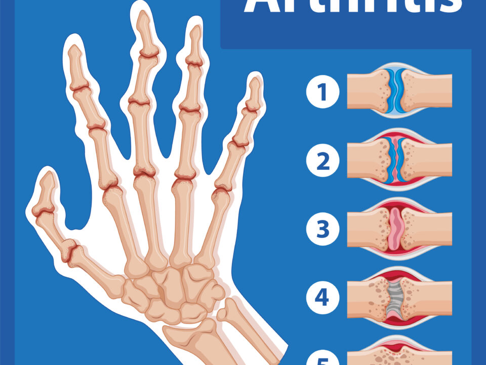 Echografie-geleide artritis-diagnose