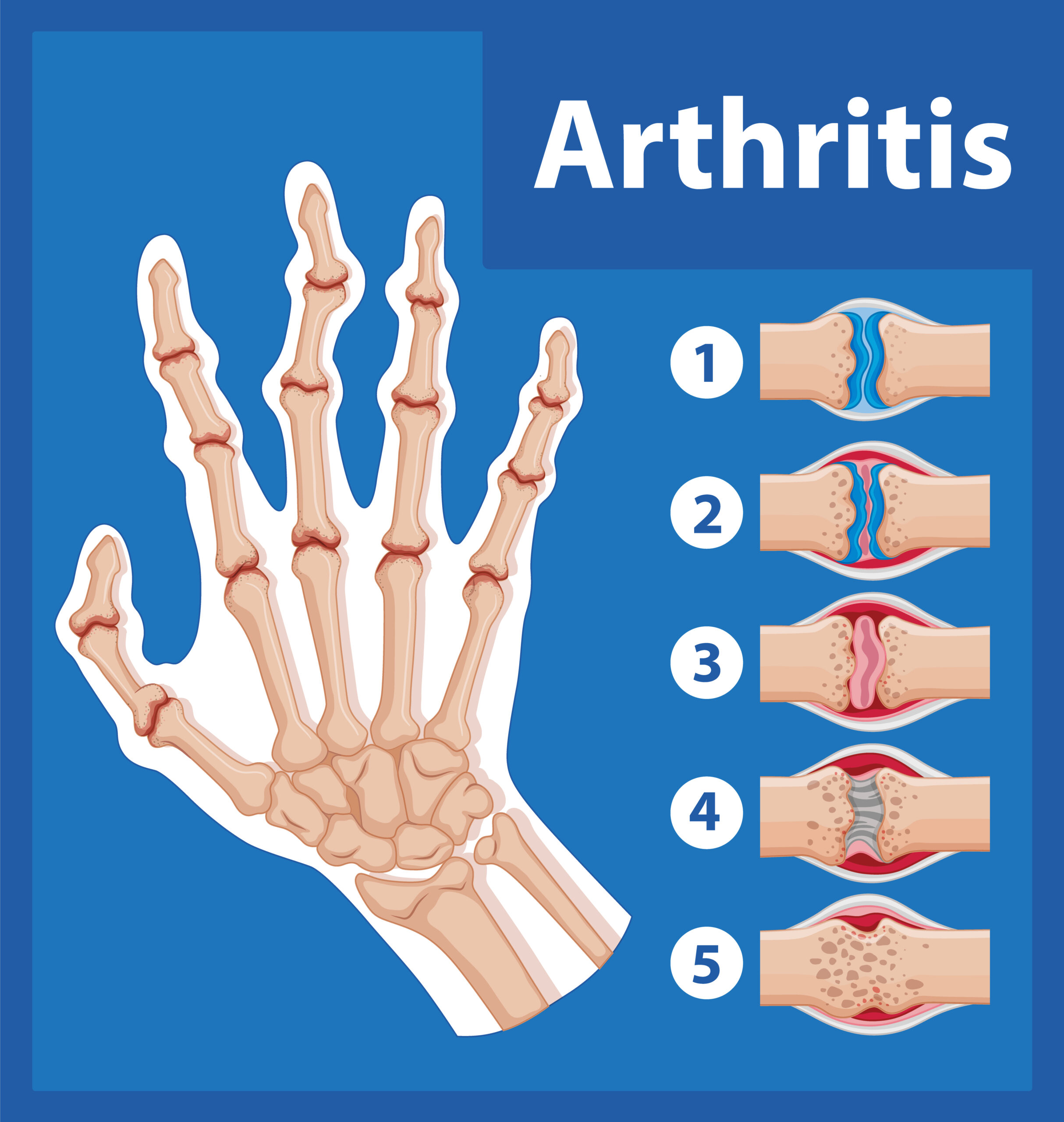 Ultrasound-guided Arthritis Diagnosis