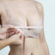 Ultrasound-guided Breast reduction