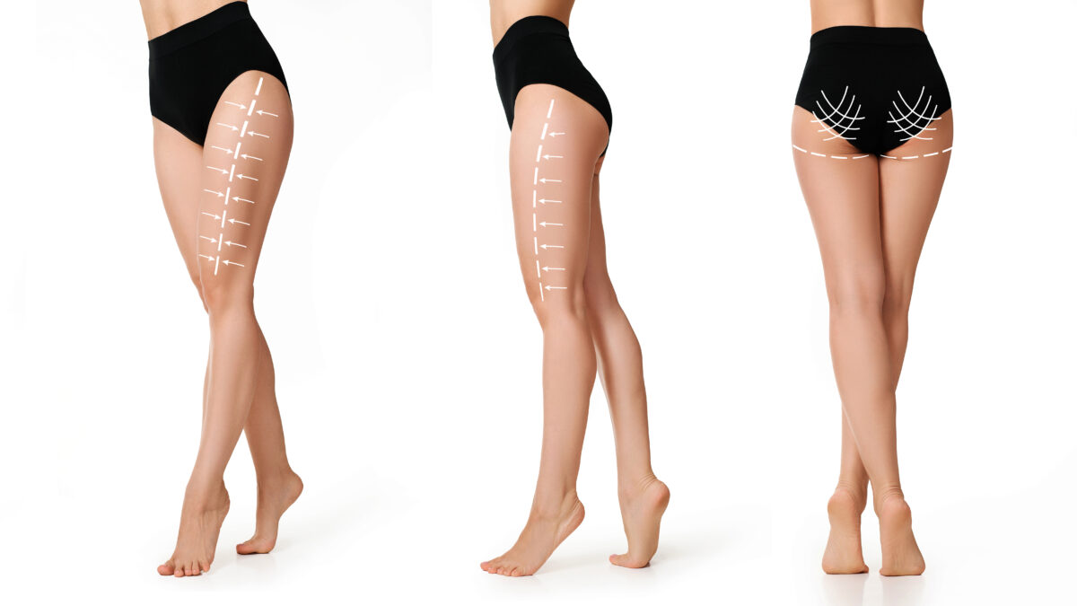 Ultrasound-guided Thigh Lift