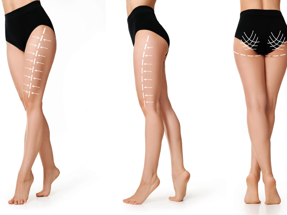 Ultrasound-guided Thigh Lift