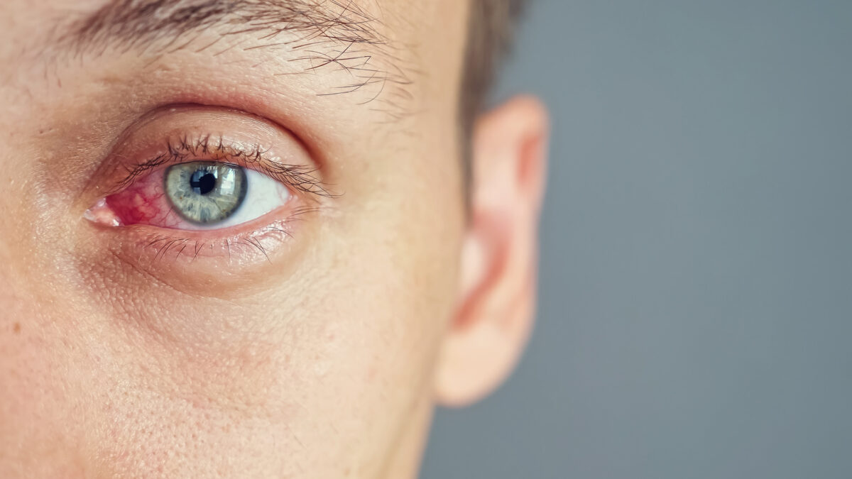 Diagnosi ecografica oculare di emorragia del vitreo