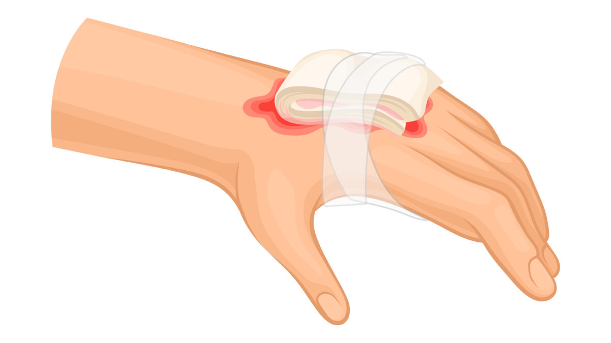 Blood Supply for Cutaneous Flap