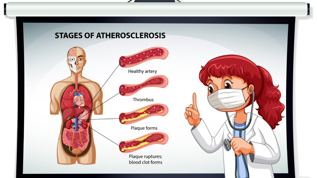 Diagnosi ecografica della stenosi dell'arteria carotide